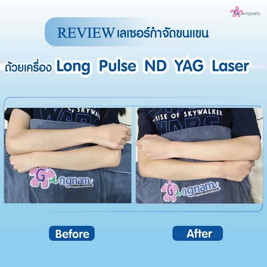 กำจัดขนแขนด้วยเครื่อง Long Pulse ND Yag