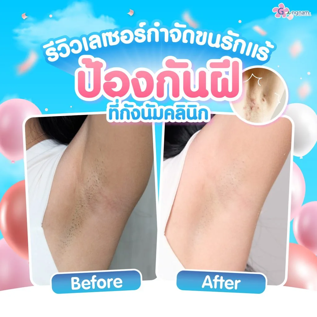 รีวิวเลเซอร์ขนรักแร้