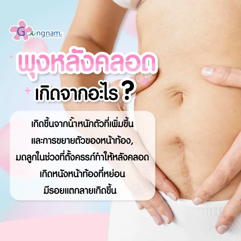 พุงหลังคลอดเกิดจากอะไร