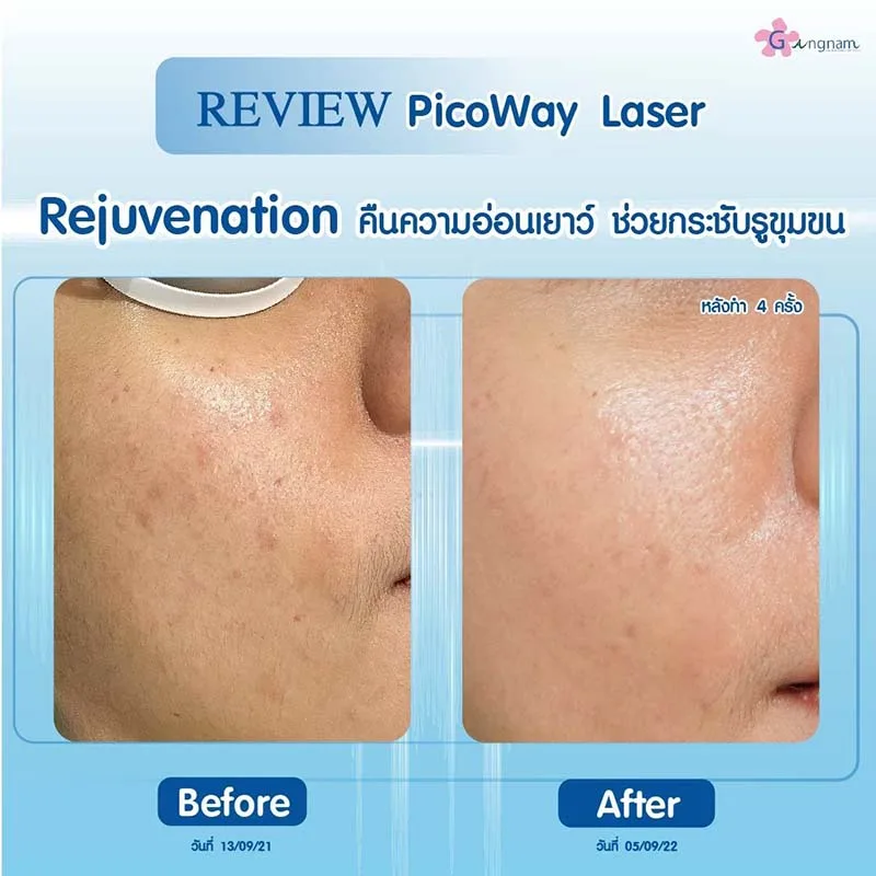 pico laser กระชับรูขุมขน