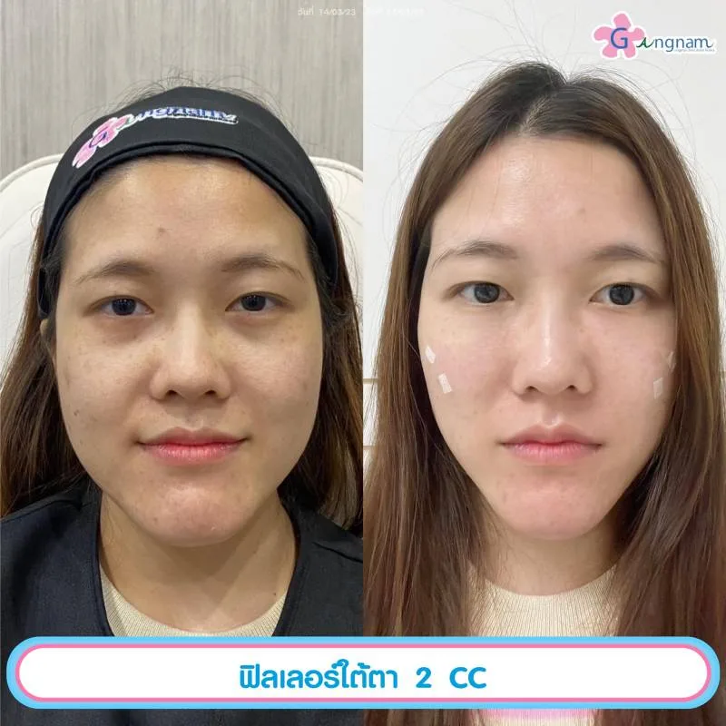 การฉีดฟิลเลอร์ใต้ตา