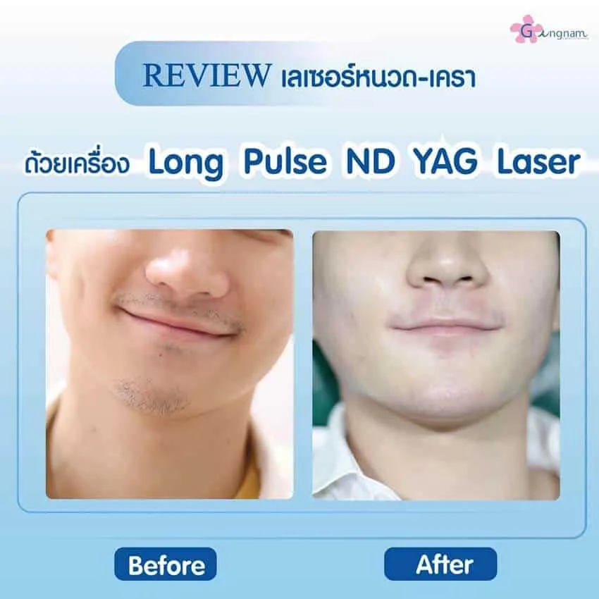 รีวิวเลเซอร์หนวด ND yag laser