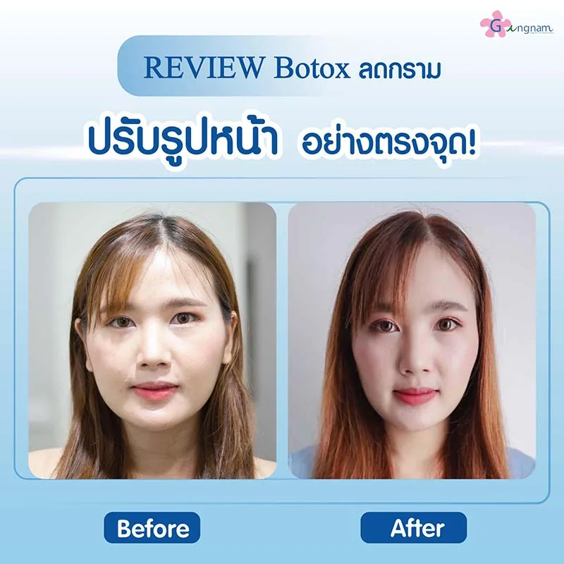 การฉีดโบท็อกลดกราม เหมาะกับใคร