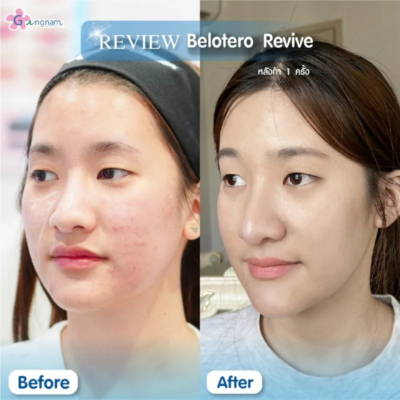 รีวิวหลังฉีด Belotero Revive