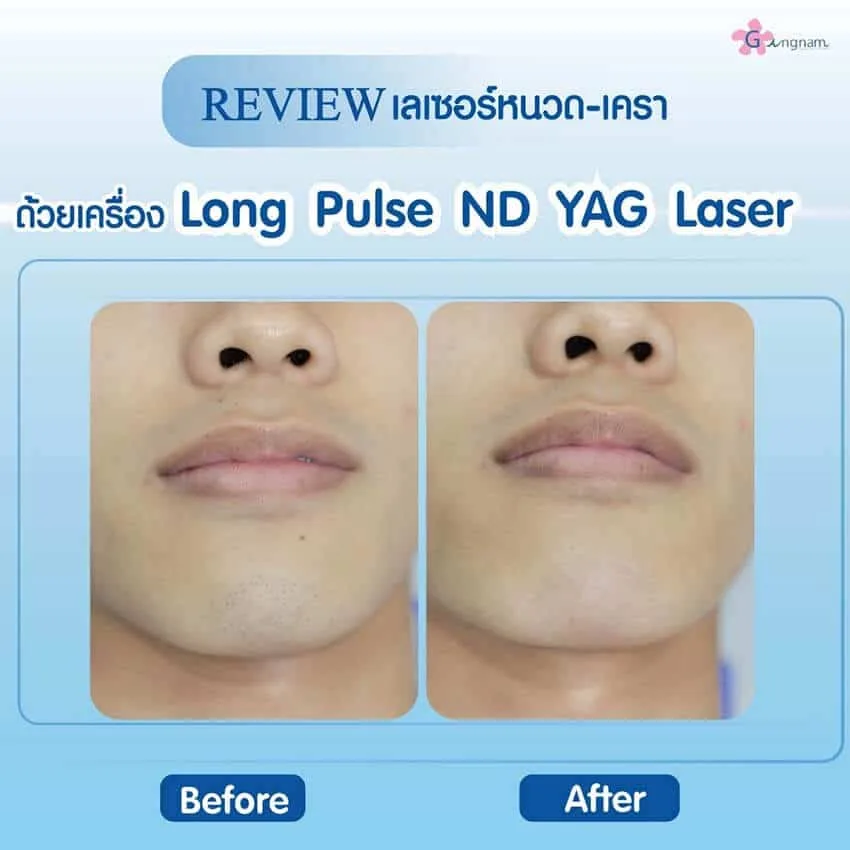 รีวิวหลังเลเซอร์หนวด และเครา