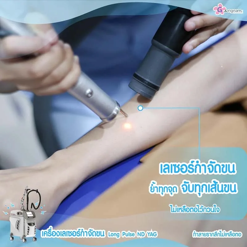 เลเซอร์ขนแขนด้วย Long Pulse Nd Yag