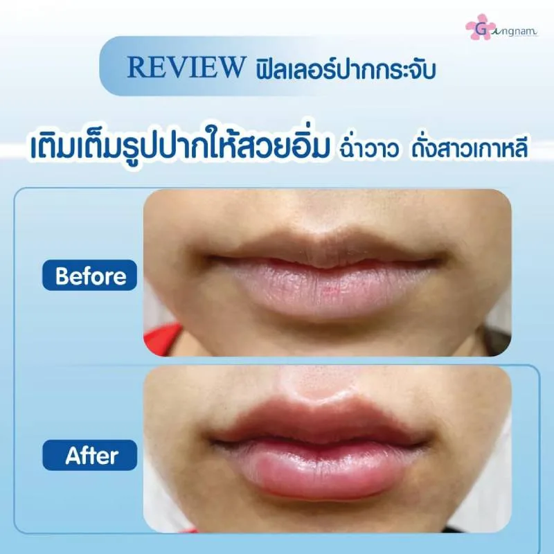 รีวิวการฉีดฟิลเลอร์ปาก 1
