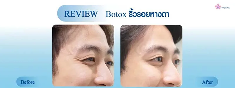 หน้าเด็กด้วยโบท็อกหางตา