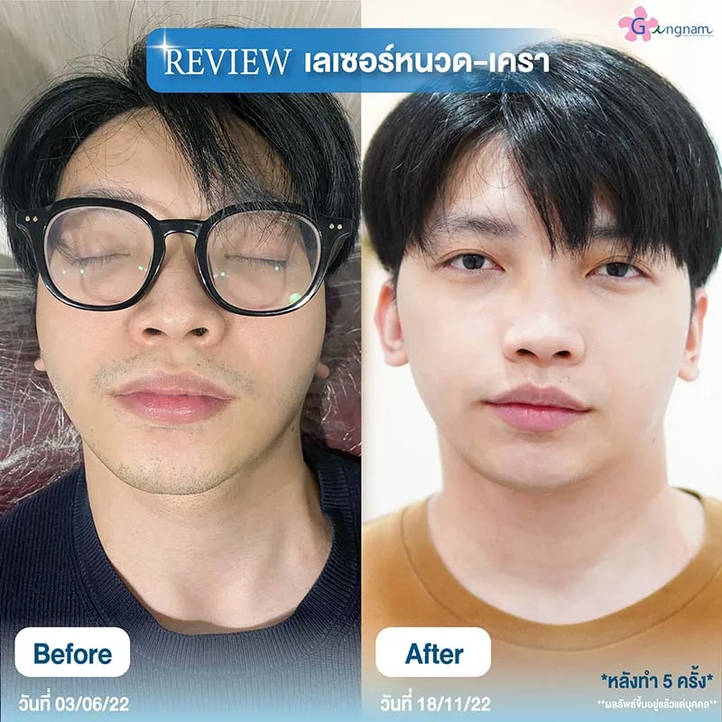 เลเซอร์หนวด-เครา